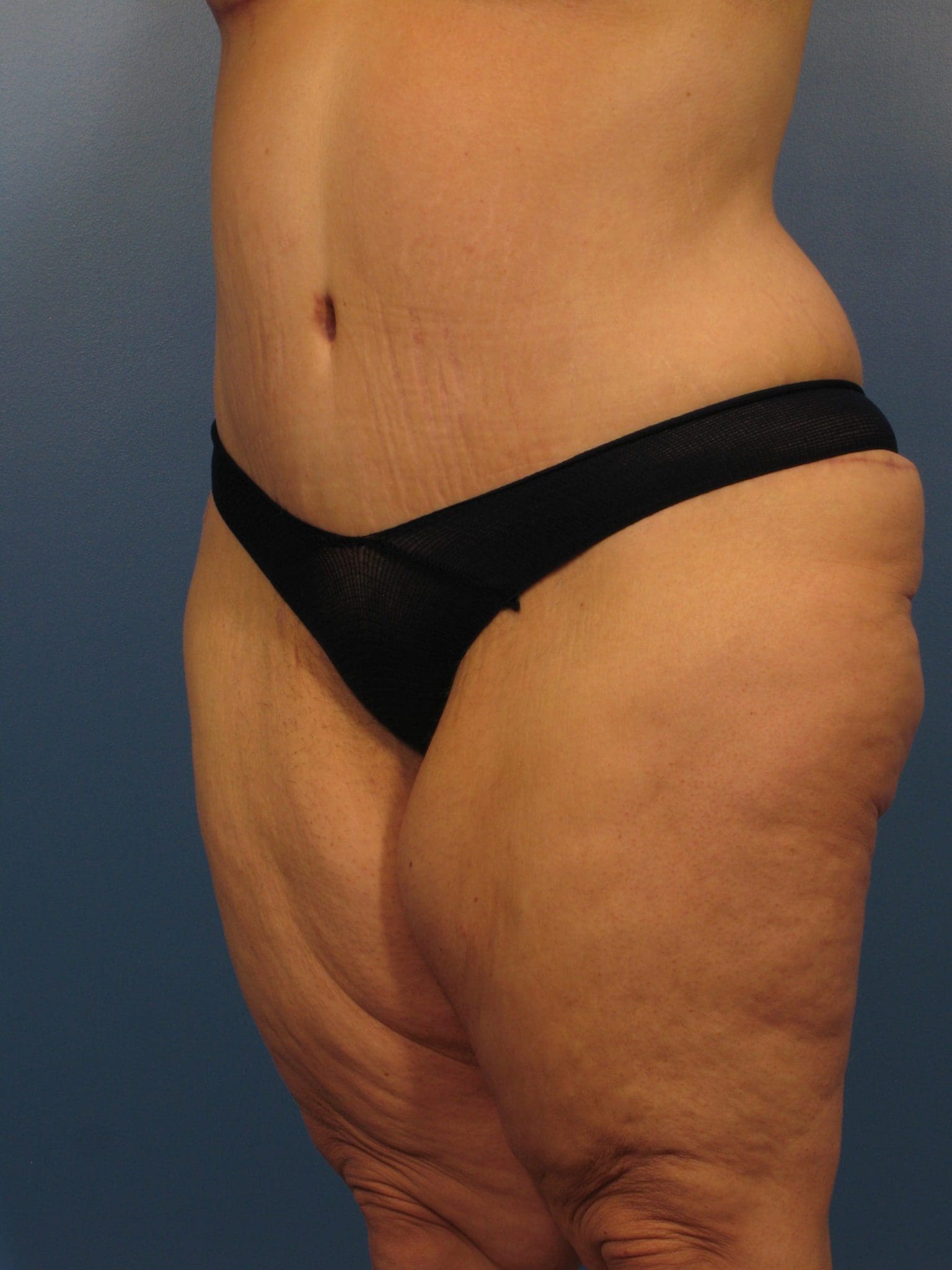 Tummy Tuck Patient Photo - Case 14361 - after view-1