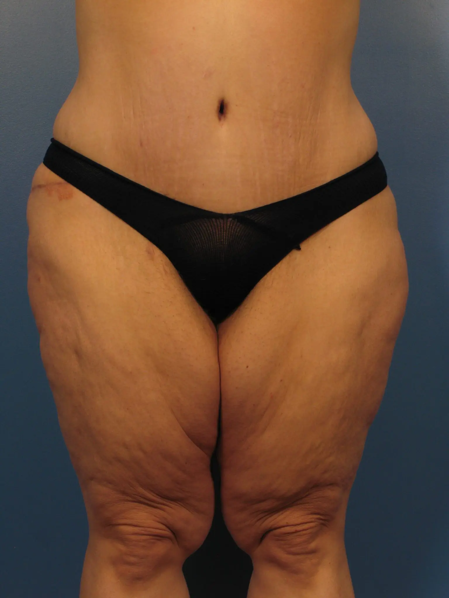 After Major Weight Loss - Case 1043 - After