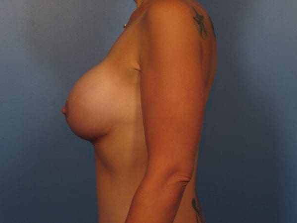 Breast Augmentation Patient Photo - Case 14367 - after view-3