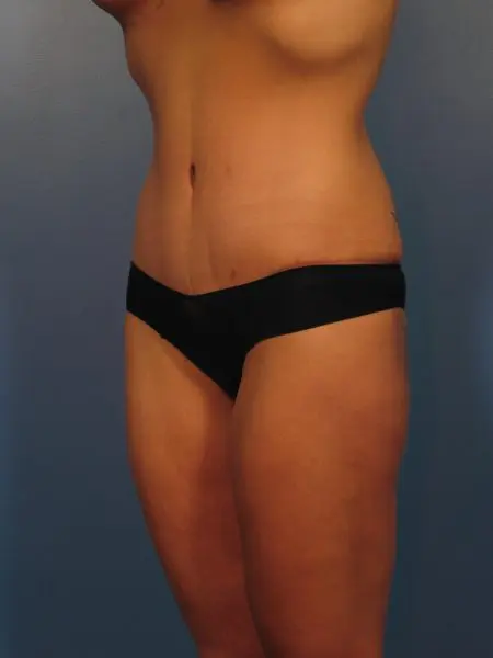 After Major Weight Loss Patient Photo - Case 1042 - after view-1