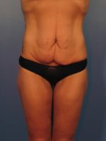 Breast Augmentation - Case 14367 - Before