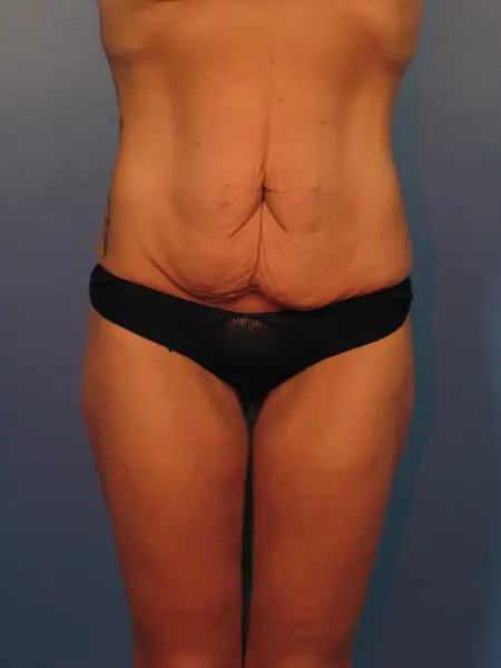 After Major Weight Loss - Case 1042 - Before