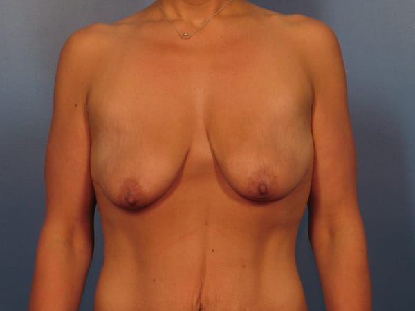 After Major Weight Loss Patient Photo - Case 1042 - before view-2