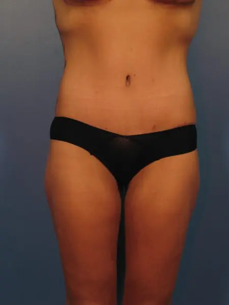After Major Weight Loss - Case 1042 - After