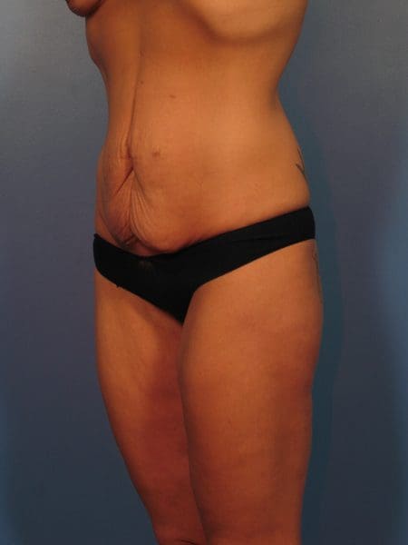 Breast Augmentation Patient Photo - Case 14367 - before view-1