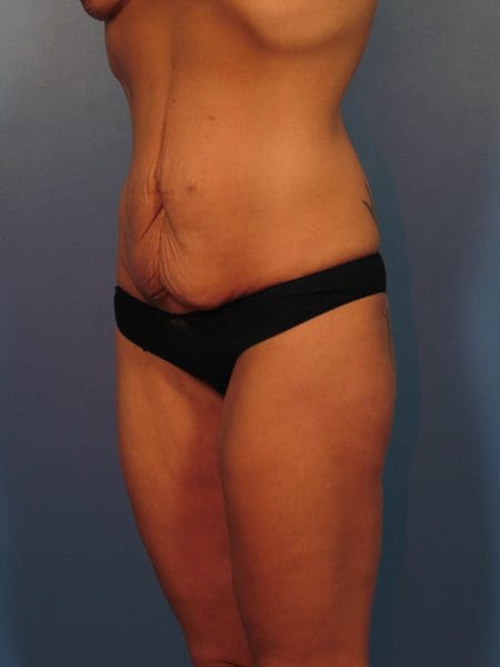 After Major Weight Loss Patient Photo - Case 1042 - before view-1