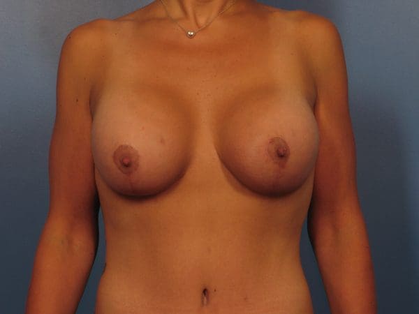 Breast Augmentation Patient Photo - Case 14367 - after view-2