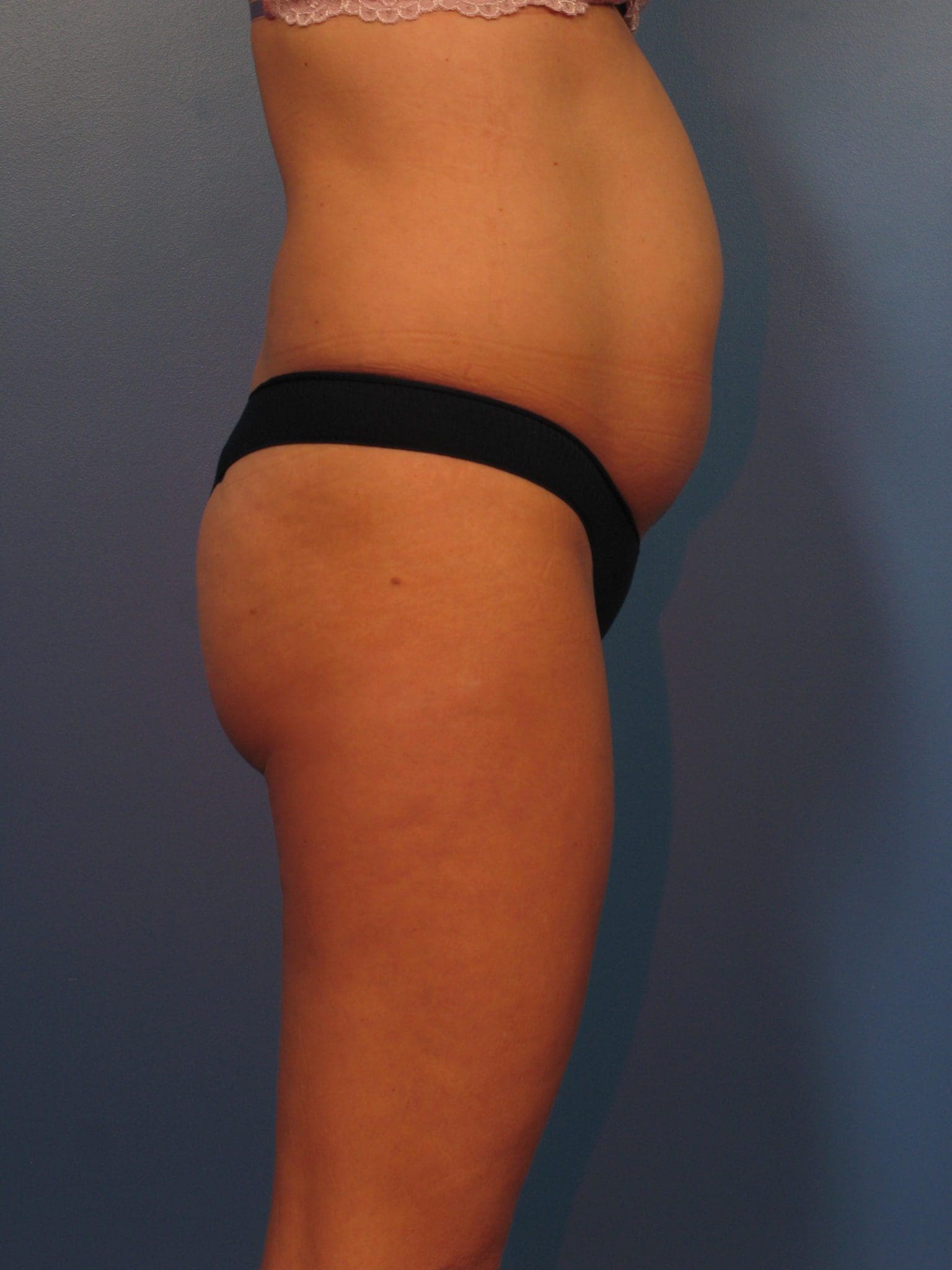 Liposuction Patient Photo - Case 14383 - before view-1