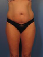 Liposuction - Case 14383 - Before