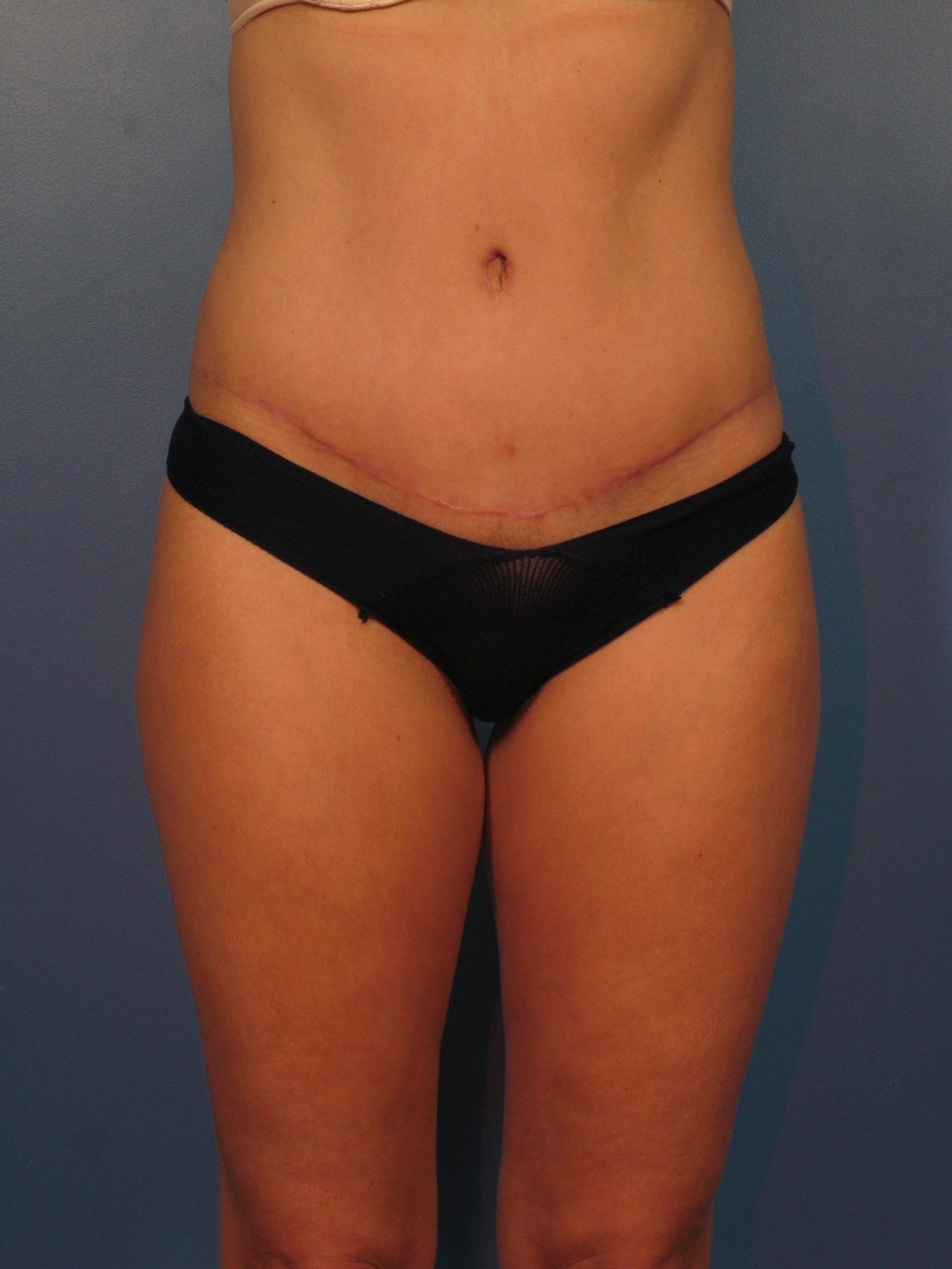 Liposuction Patient Photo - Case 14383 - after view