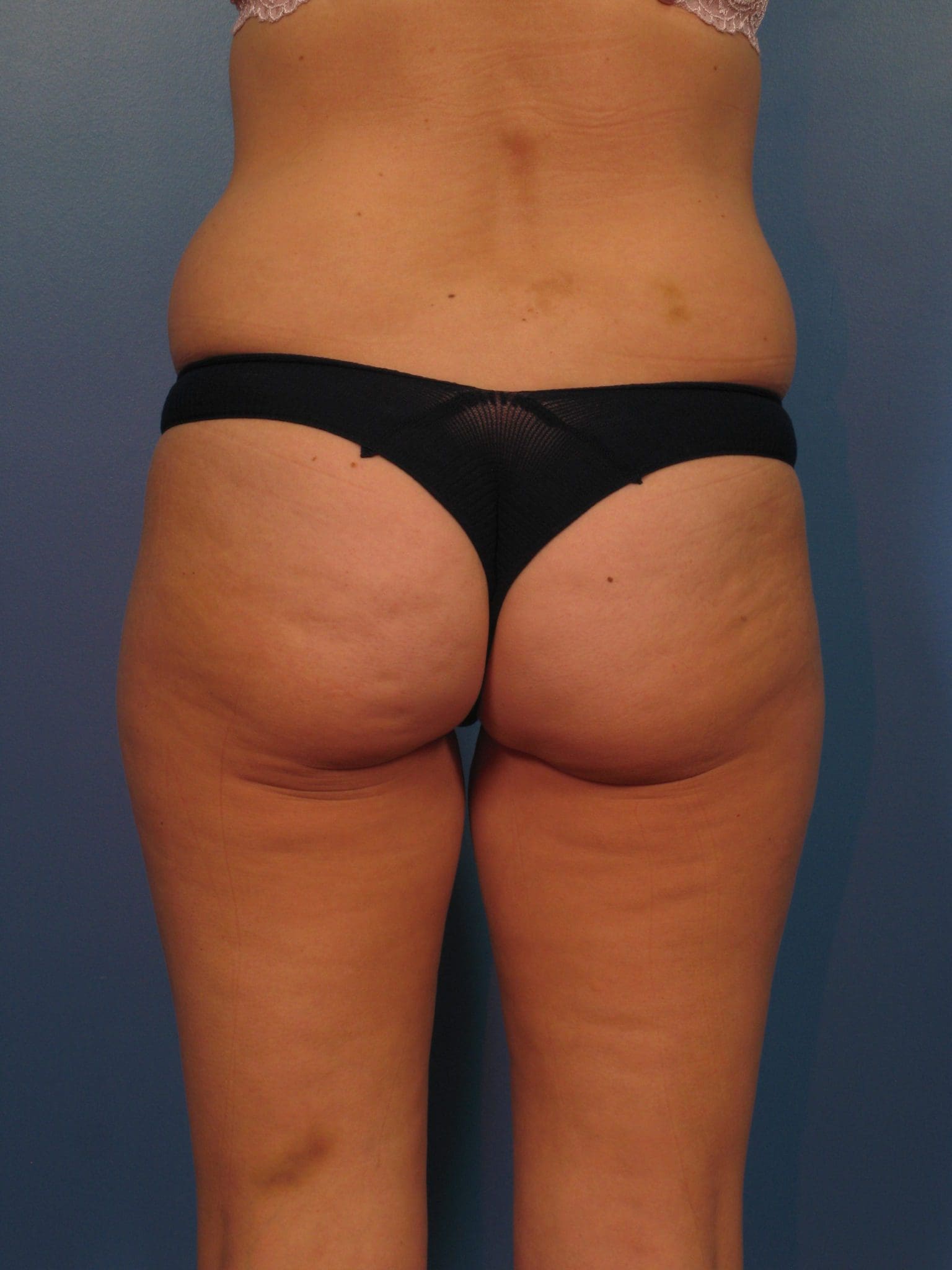 Liposuction Patient Photo - Case 14383 - before view-2
