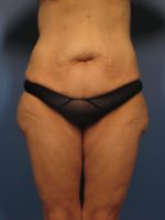 After Major Weight Loss - Case 350 - Before