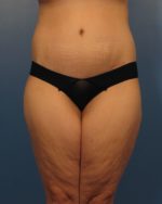 Tummy Tuck - Case 433a - After