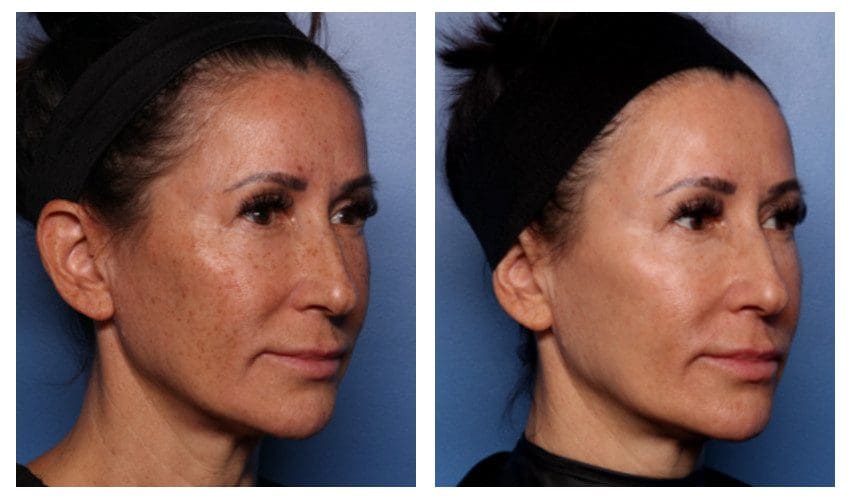 laser skin rejuvenation patient
