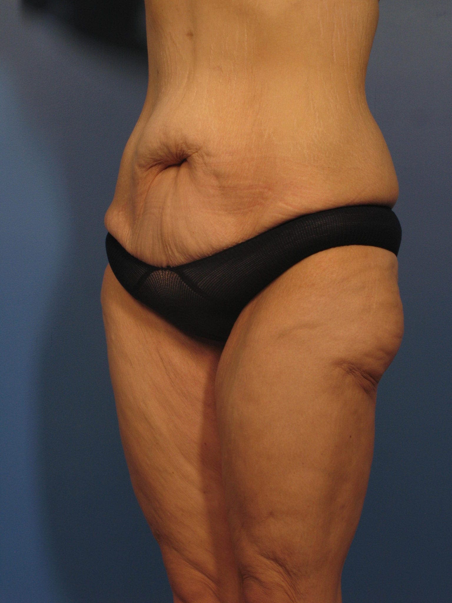 After Major Weight Loss Patient Photo - Case 350 - before view-1