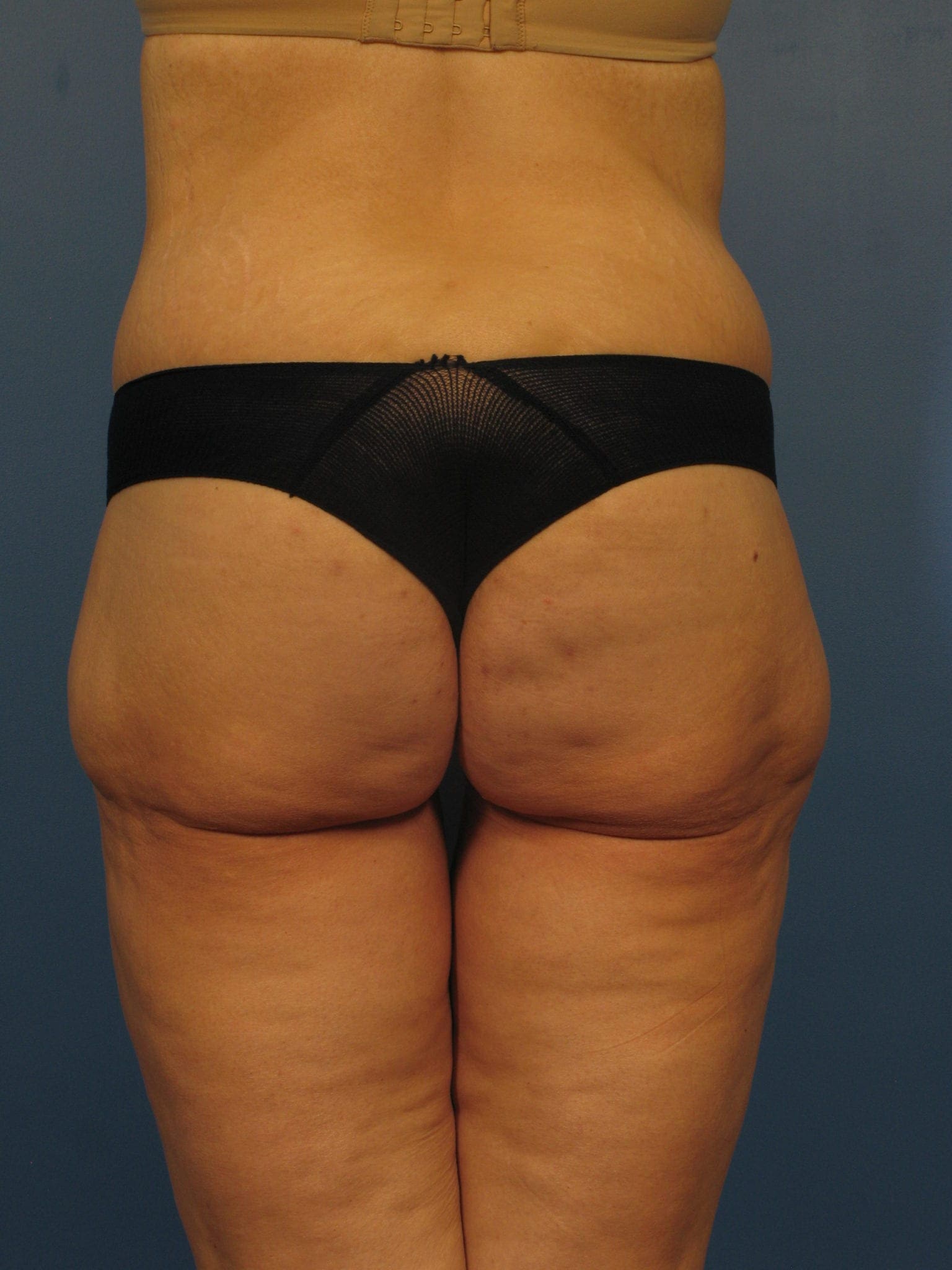 After Major Weight Loss Patient Photo - Case 350 - after view-2