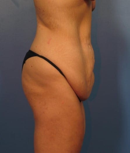 After Major Weight Loss Patient Photo - Case 415 - before view-2
