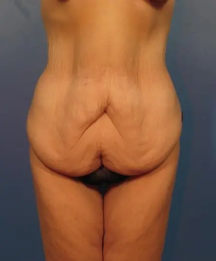 After Major Weight Loss Patient Photo - Case 415 - before view-