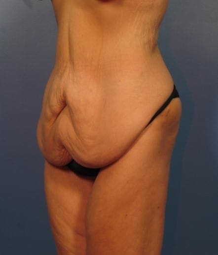 After Major Weight Loss Patient Photo - Case 415 - before view-1