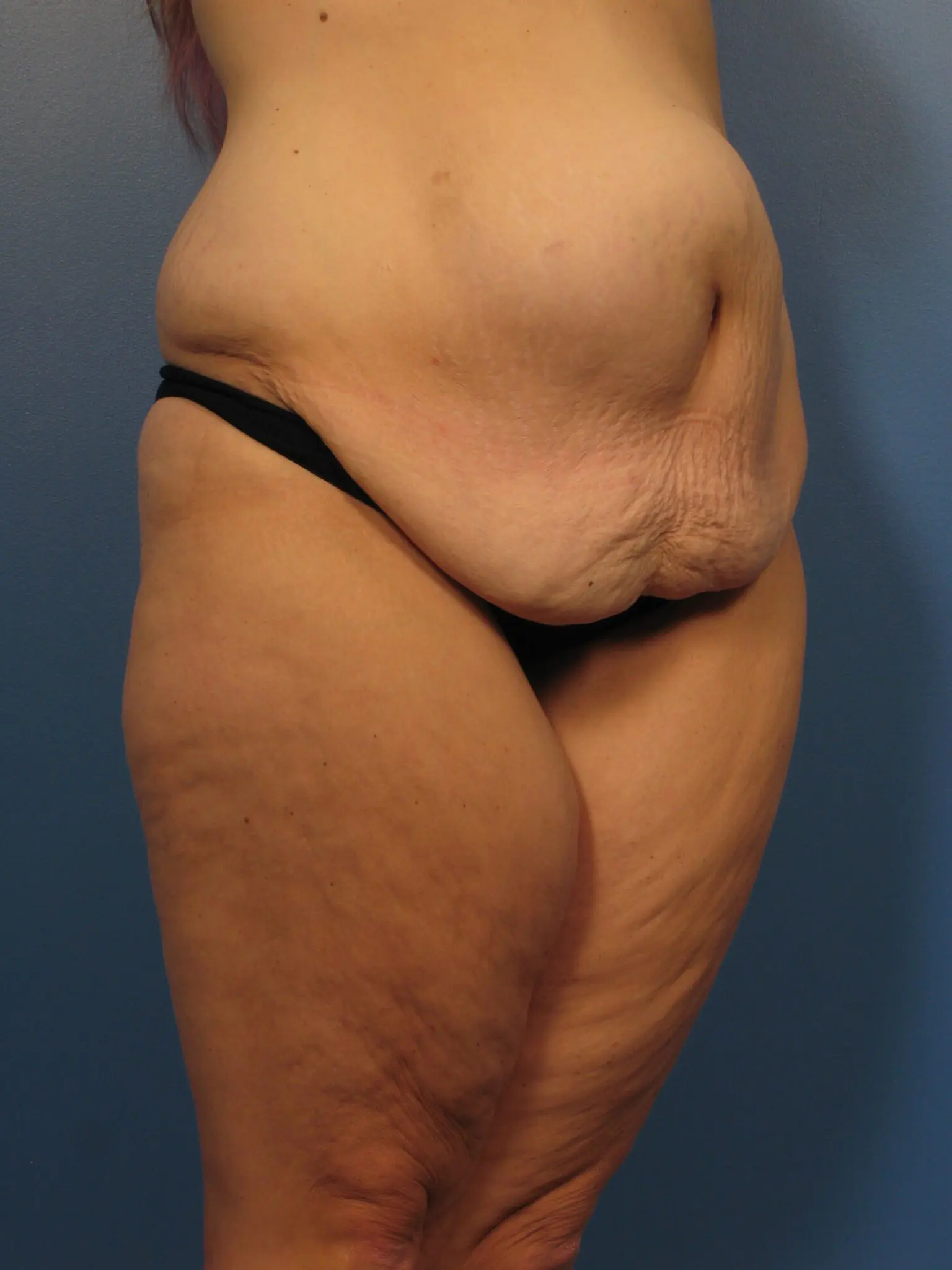 After Major Weight Loss Patient Photo - Case 433a - before view-1
