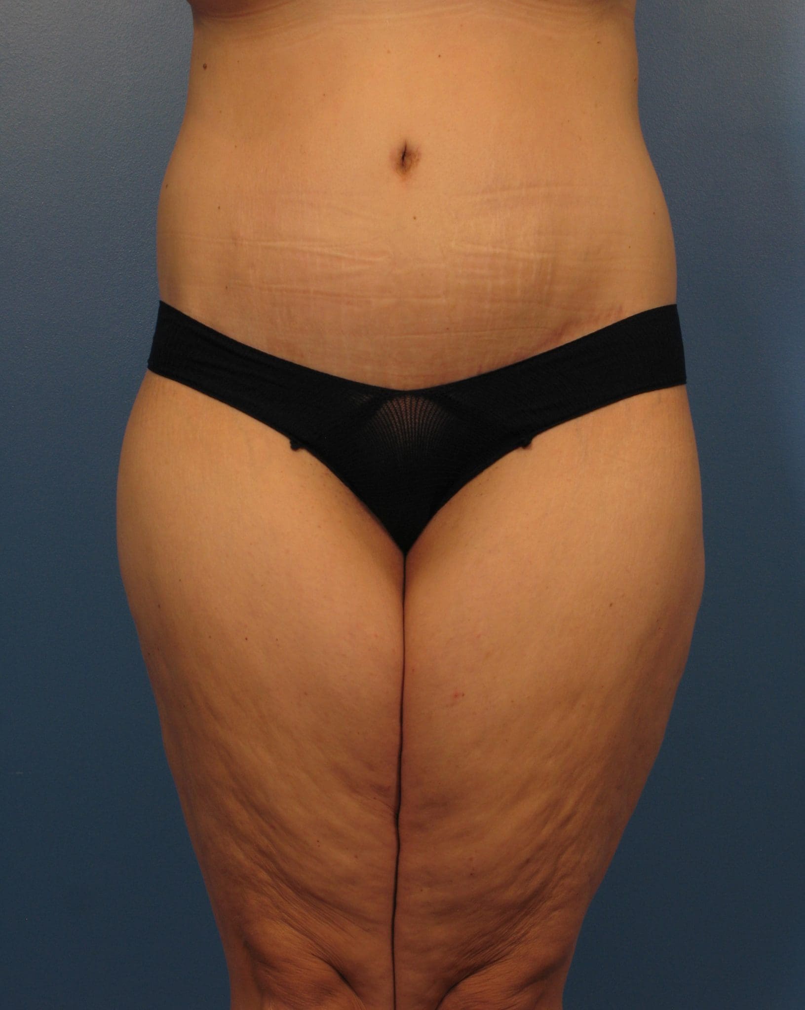Tummy Tuck Patient Photo - Case 433a - after view
