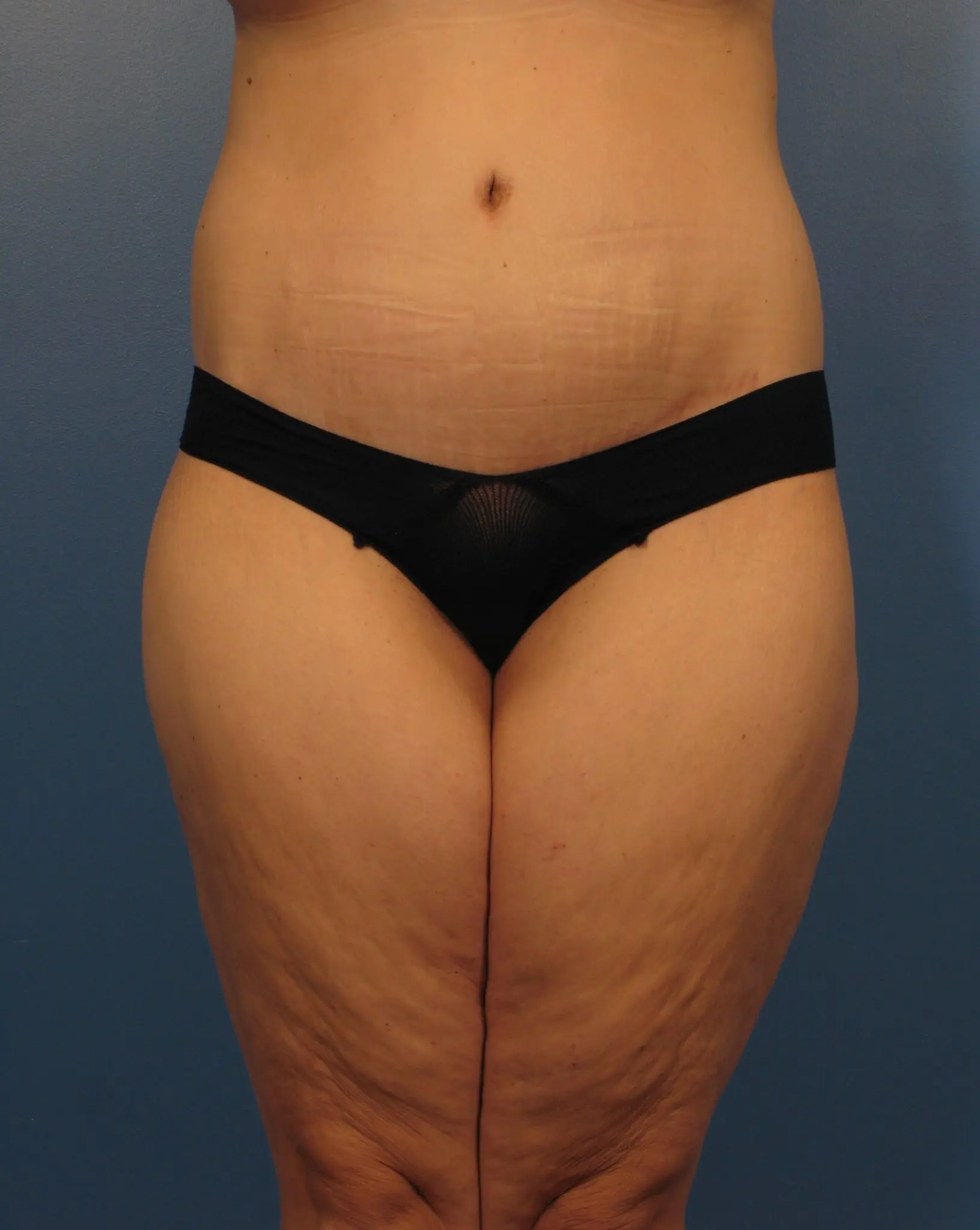 After Major Weight Loss - Case 433a - After