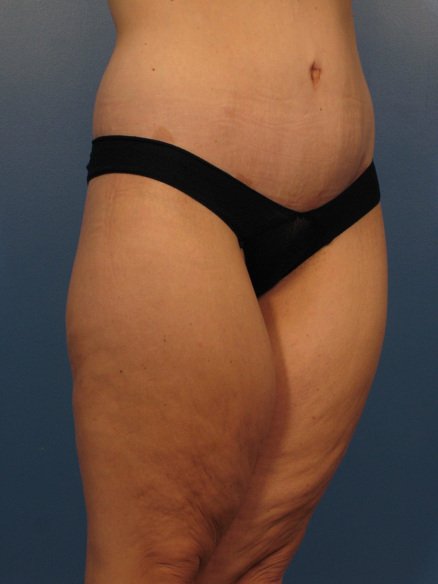 After Major Weight Loss Patient Photo - Case 433a - after view-1