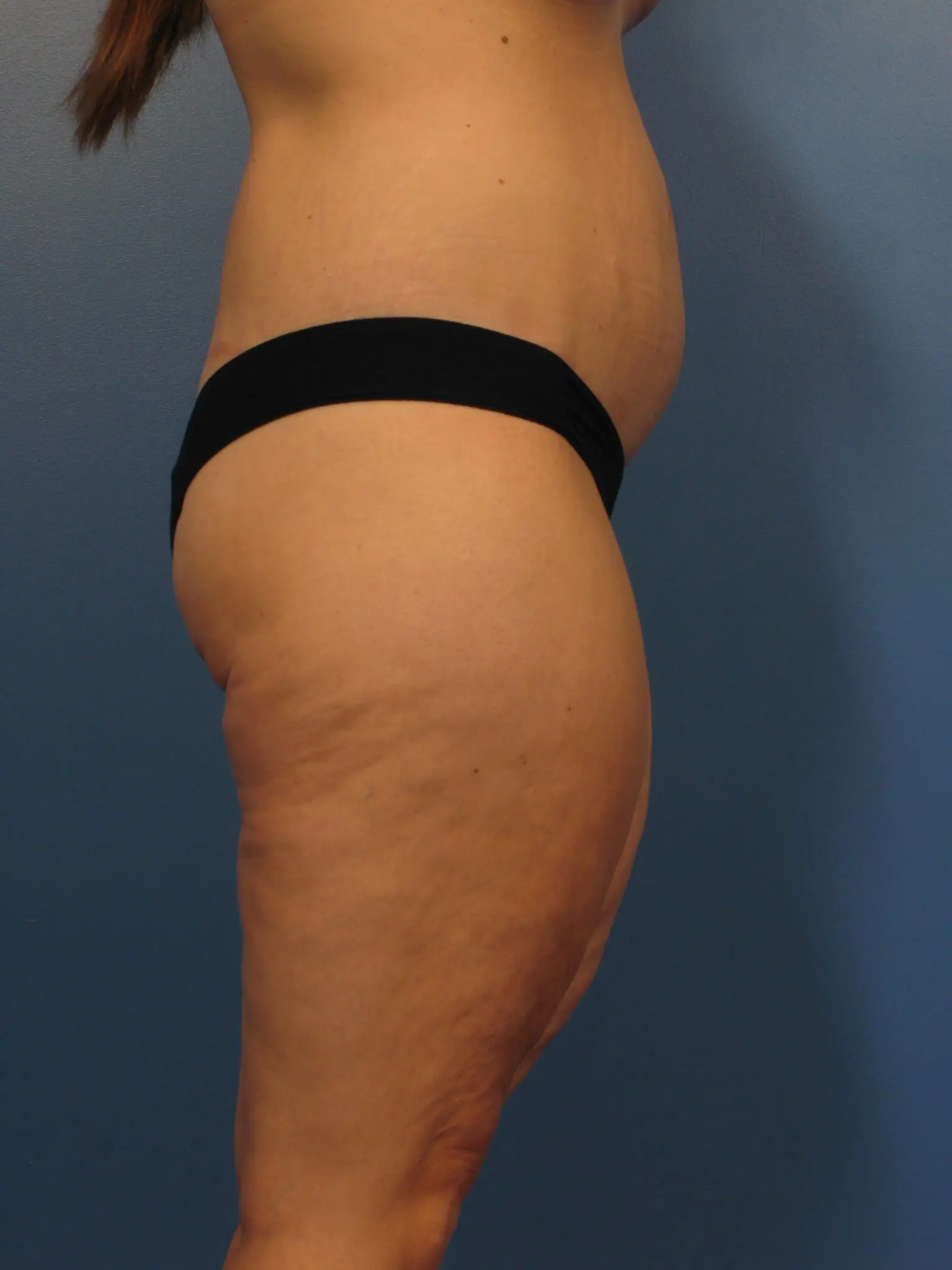 After Major Weight Loss Patient Photo - Case 433a - after view-2