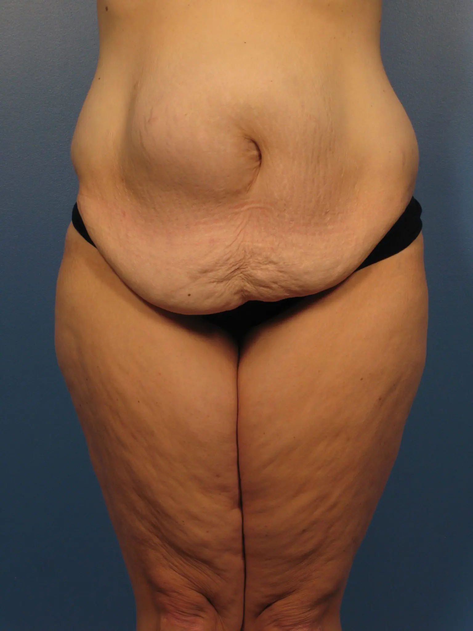 After Major Weight Loss - Case 433a - Before