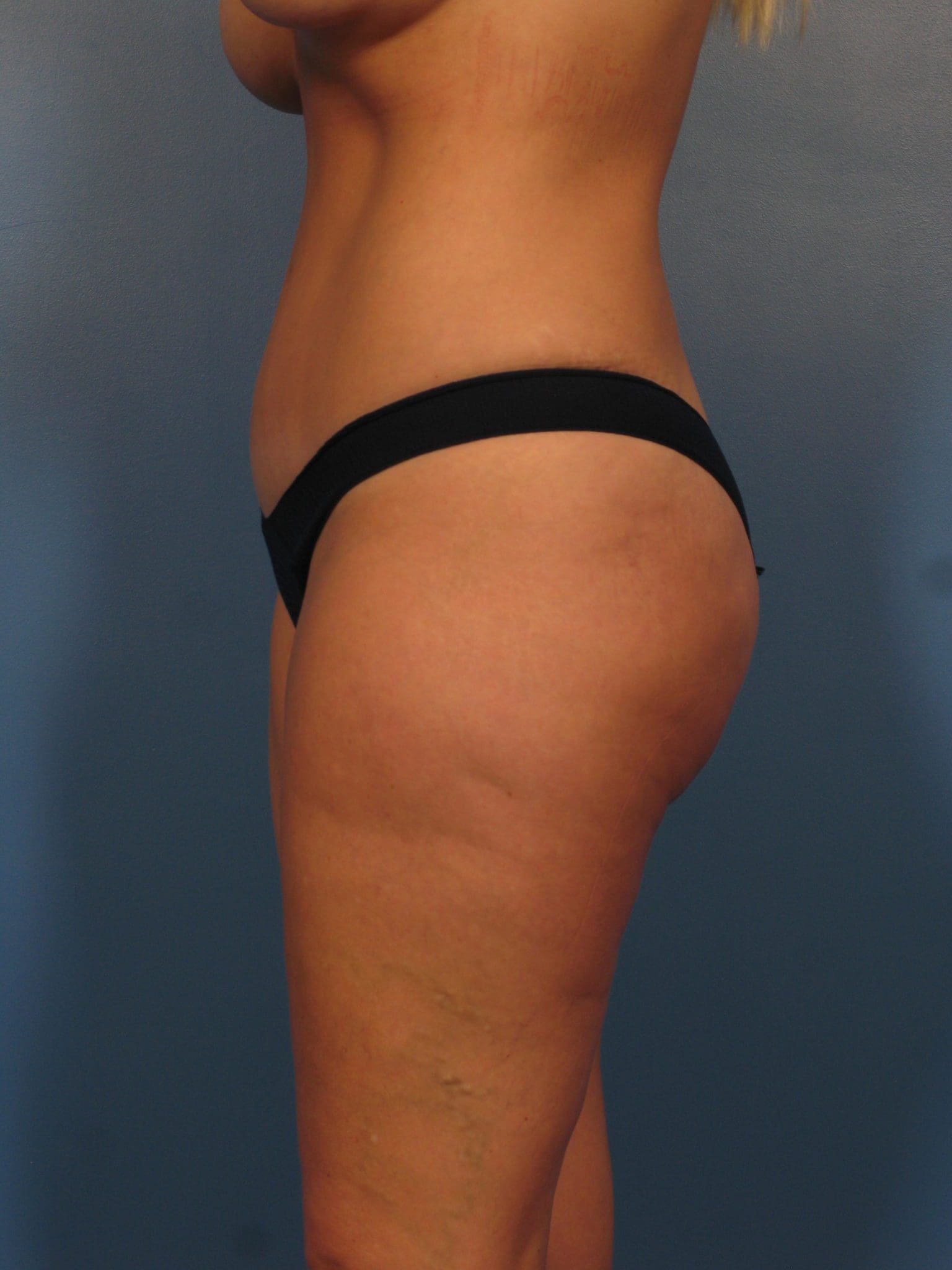 Liposuction Patient Photo - Case 432 - after view-2
