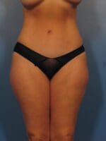 Liposuction - Case 432 - After
