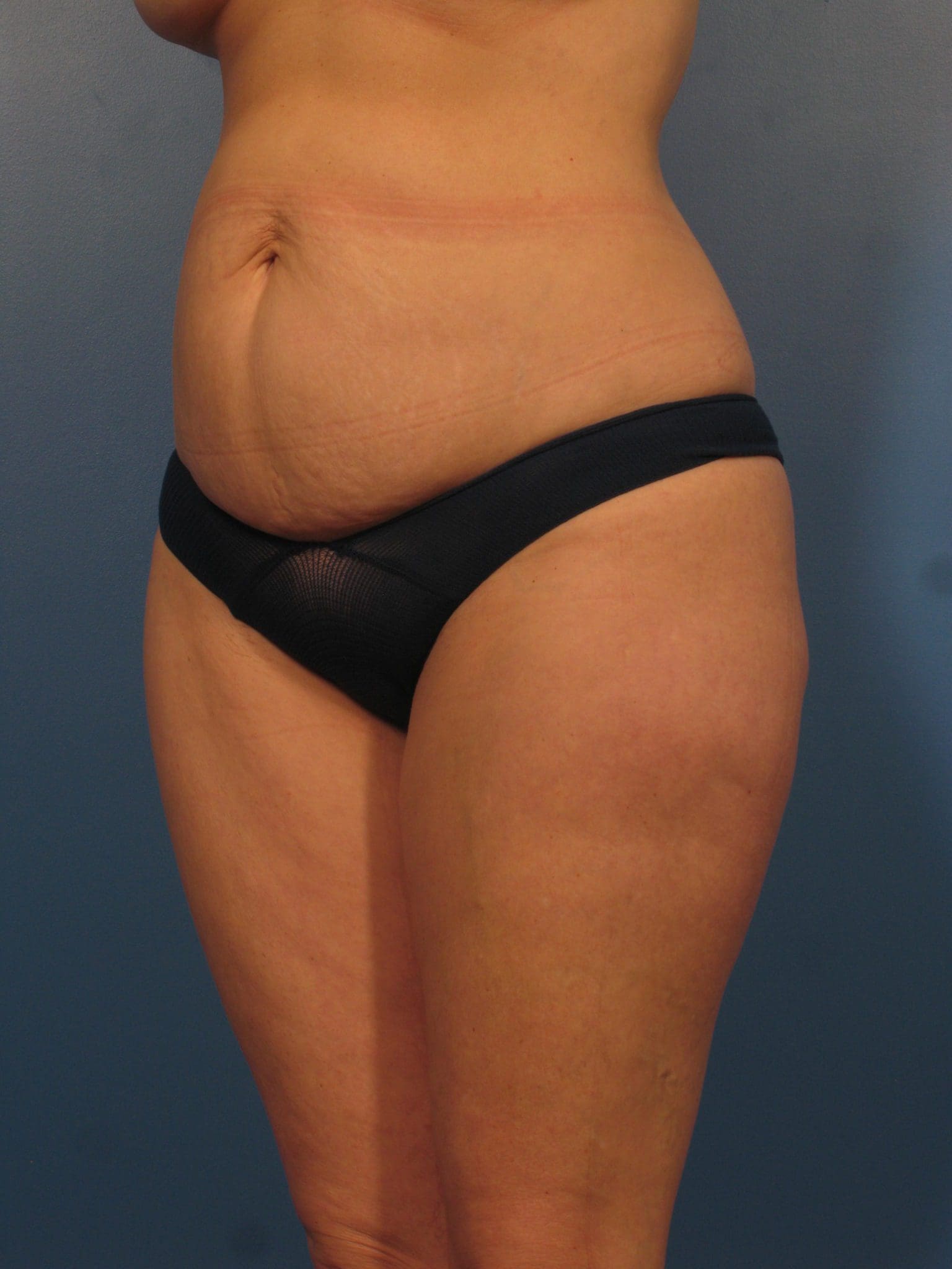 Liposuction Patient Photo - Case 432 - before view-1