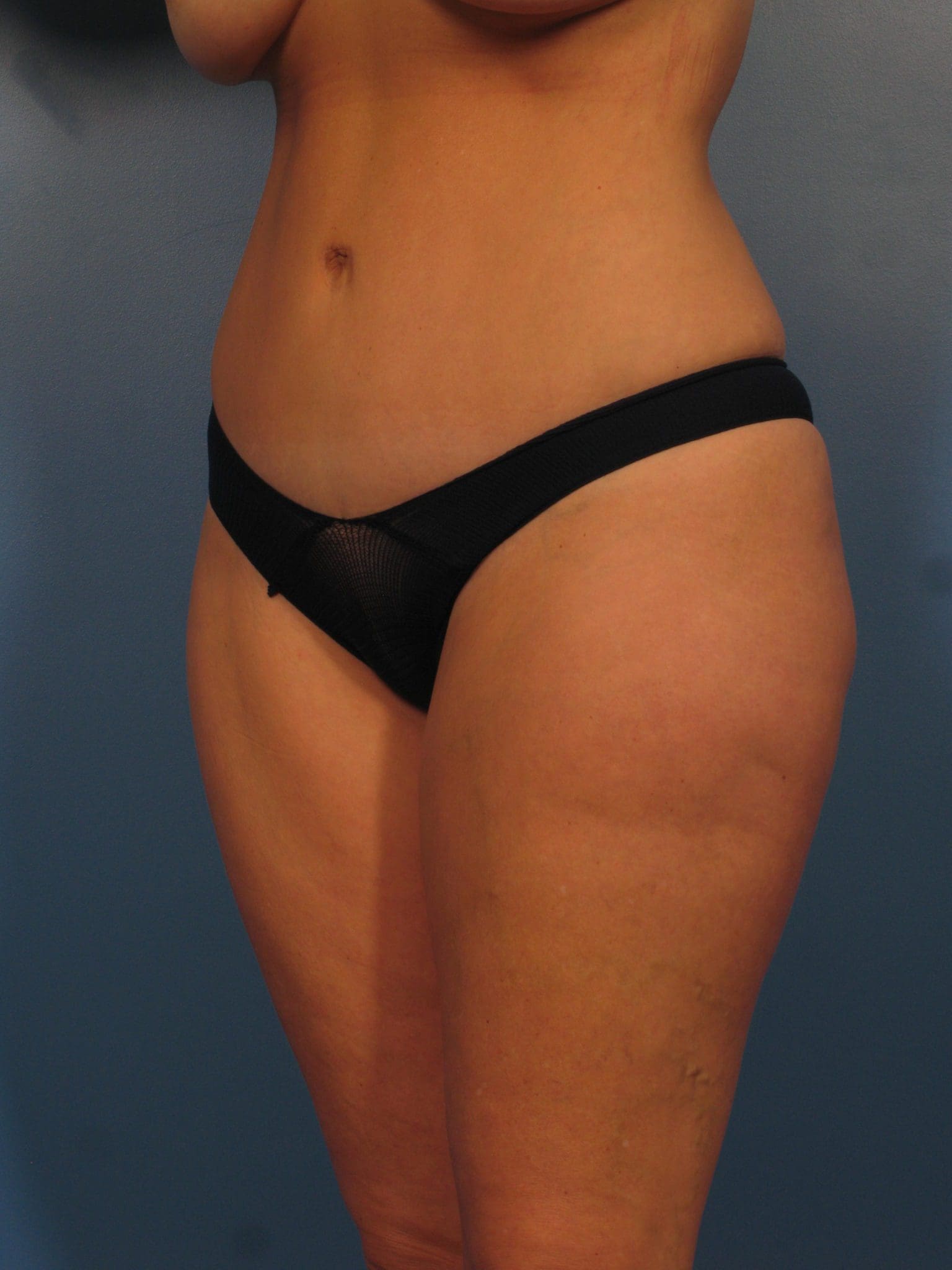 Liposuction Patient Photo - Case 432 - after view-1