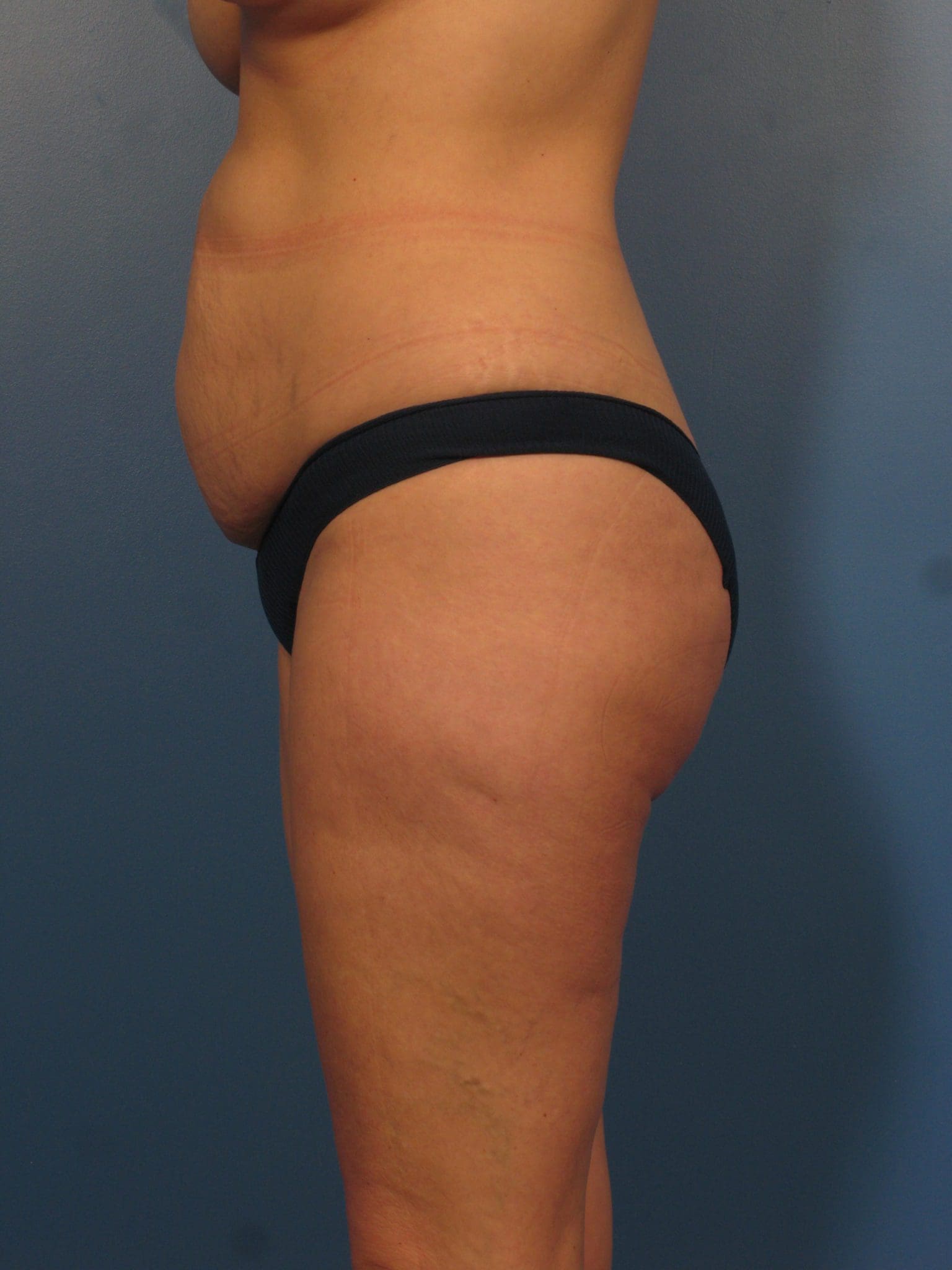 Liposuction Patient Photo - Case 432 - before view-2