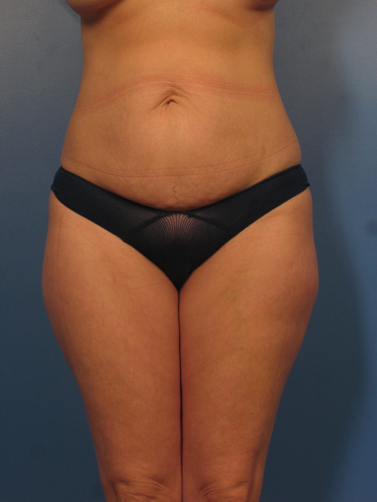 Liposuction - Case 432 - Before