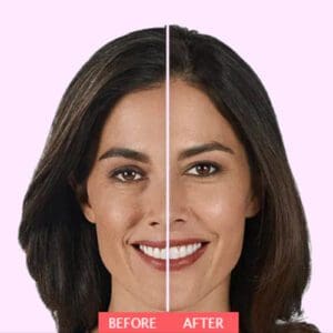 Voluma before and after