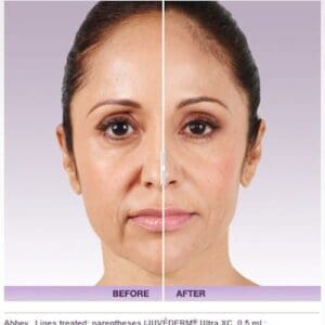 Dermal Fillers Product