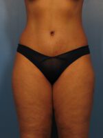 Tummy Tuck - Case 1024 - After