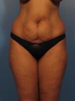Tummy Tuck - Case 1024 - Before