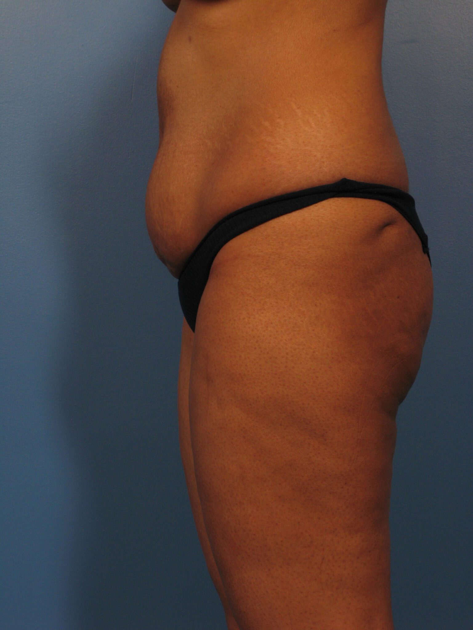 Tummy Tuck Patient Photo - Case 1024 - before view-1