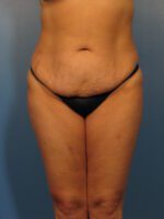 Tummy Tuck - Case 1025 - Before