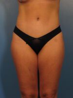 Tummy Tuck - Case 1025 - After