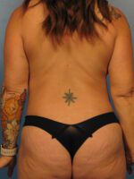Liposuction - Case 1021 - After