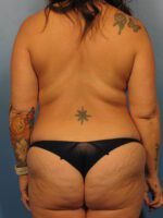 Liposuction - Case 1021 - Before