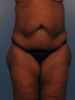 Tummy Tuck - Case 1026 - Before