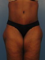 Tummy Tuck - Case 1026 - After