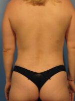 Liposuction - Case 1028 - After