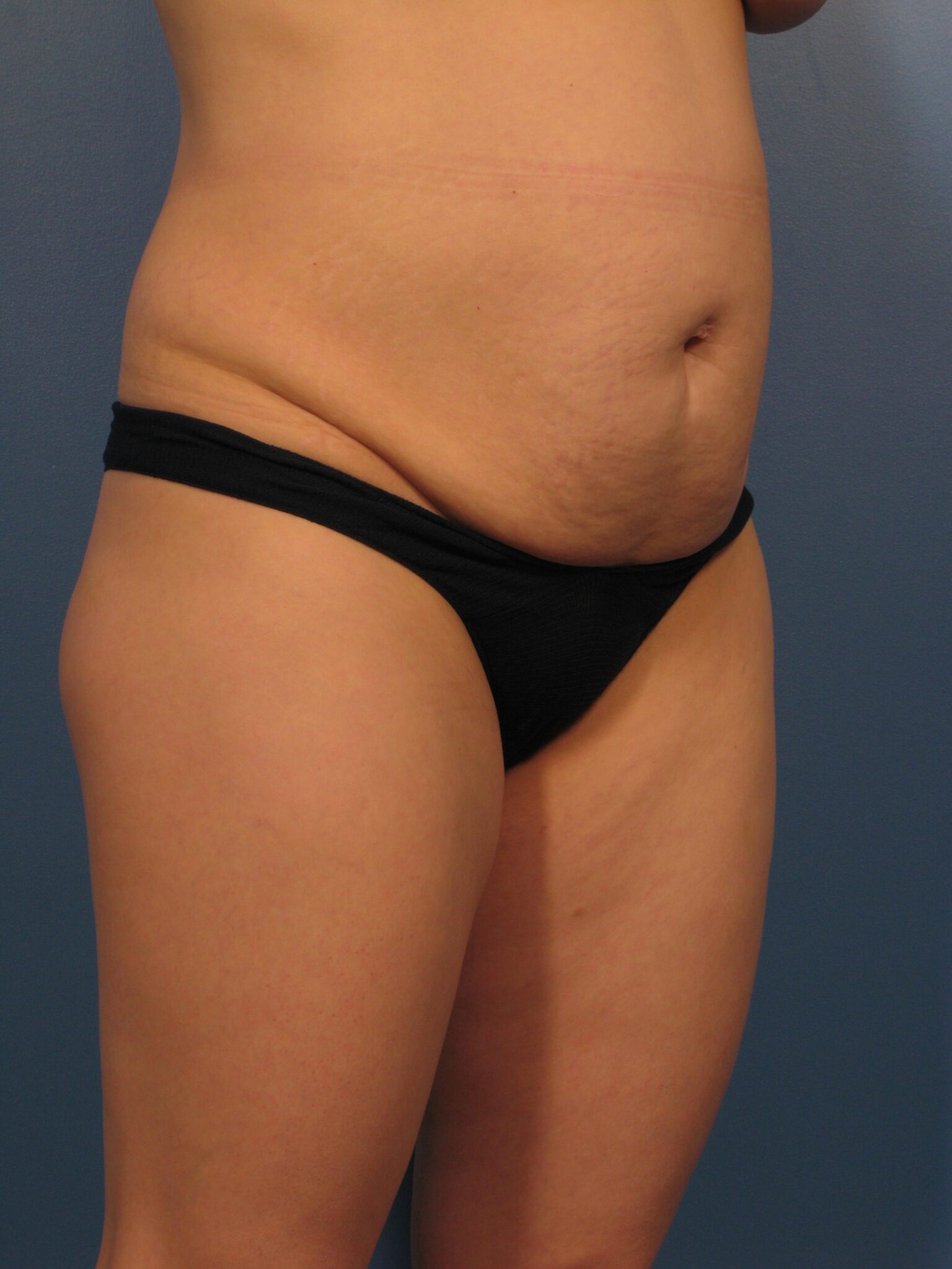 Tummy Tuck Patient Photo - Case 1027 - before view-1