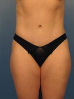 Tummy Tuck - Case 1027 - After