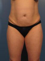 Tummy Tuck - Case 1027 - Before